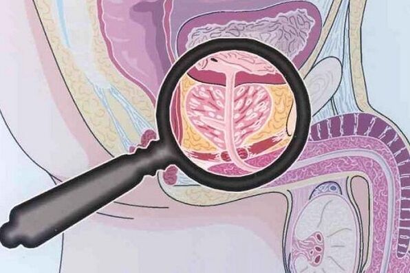 Prostatit hastalığı